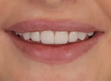 Smil etter behandling 1