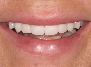 Smil etter behandling 4