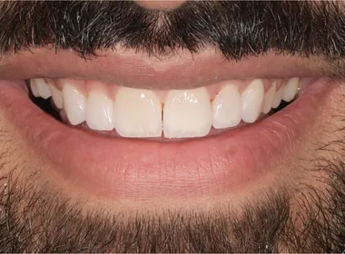Smil etter behandling 5